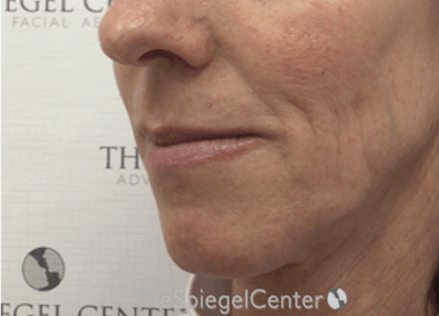 Lip Lift Before & After Gallery - Patient 183203 - Image 3