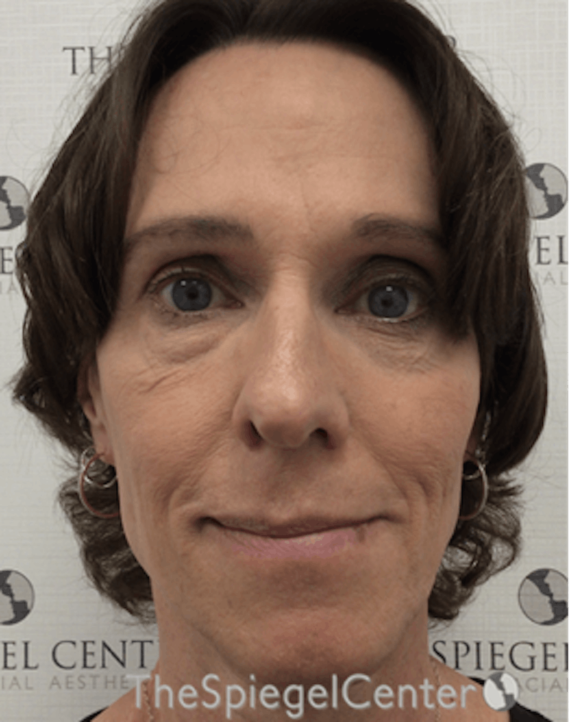 FFS Before & After Gallery - Patient 521947 - Image 1