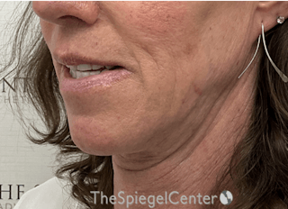 Mandible Contouring Before & After Gallery - Patient 396666 - Image 4