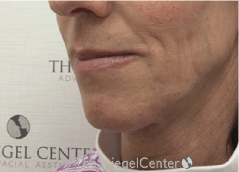 Mandible Contouring Before & After Gallery - Patient 396666 - Image 3