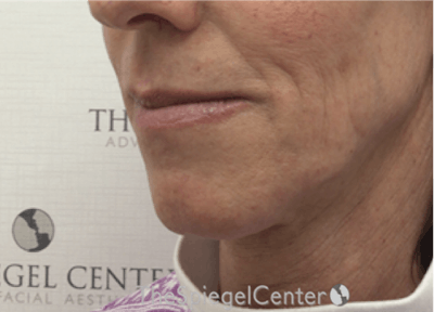 Mandible Contouring Before & After Gallery - Patient 396666 - Image 3