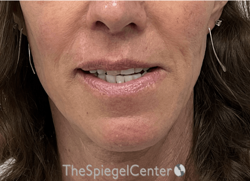 Mandible Contouring Before & After Gallery - Patient 396666 - Image 2