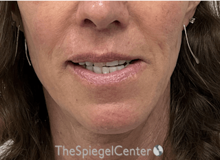 Mandible Contouring Before & After Gallery - Patient 396666 - Image 2