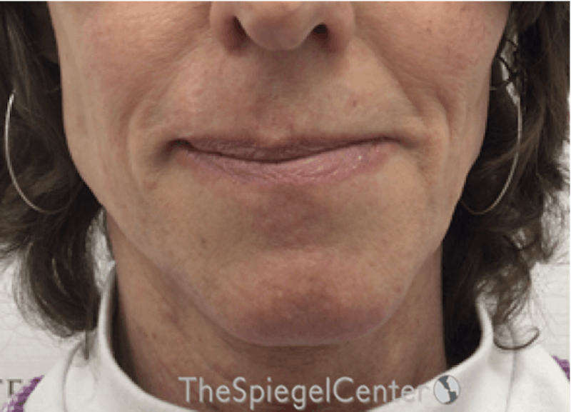 Mandible Contouring Before & After Gallery - Patient 396666 - Image 1