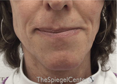 Mandible Contouring Before & After Gallery - Patient 396666 - Image 1