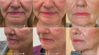 Ellacor Before & After Gallery - Patient 395361 - Image 1