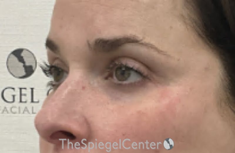 Tear Trough / Under Eye Fillers Before & After Gallery - Patient 168412 - Image 4