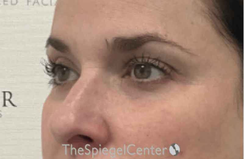 Tear Trough / Under Eye Fillers Before & After Gallery - Patient 168412 - Image 3