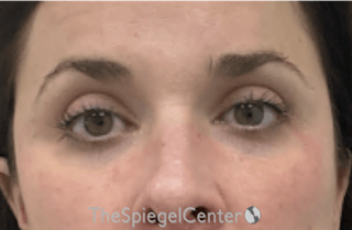Tear Trough / Under Eye Fillers Before & After Gallery - Patient 168412 - Image 2
