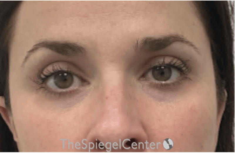 Tear Trough / Under Eye Fillers Before & After Gallery - Patient 168412 - Image 1