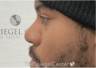 Non-Surgical Rhinoplasty / Nose Filler Before & After Gallery - Patient 137346 - Image 4