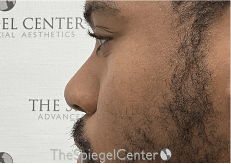 Non-Surgical Rhinoplasty / Nose Filler Before & After Gallery - Patient 137346 - Image 3