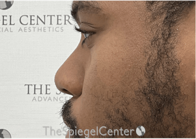 Non-Surgical Rhinoplasty / Nose Filler Before & After Gallery - Patient 137346 - Image 3