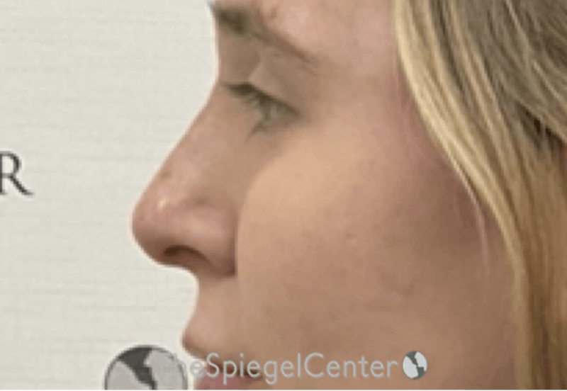 Non-Surgical Rhinoplasty / Nose Filler Before & After Gallery - Patient 314585 - Image 4