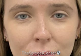 Non-Surgical Rhinoplasty / Nose Filler Before & After Gallery - Patient 314585 - Image 2
