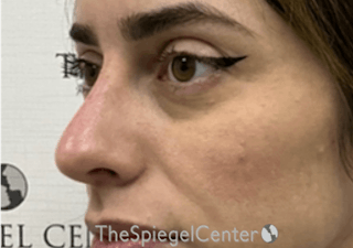 Non-Surgical Rhinoplasty / Nose Filler Before & After Gallery - Patient 173666 - Image 4