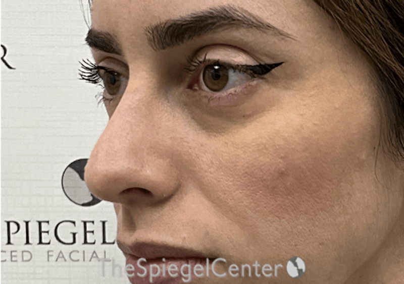 Non-Surgical Rhinoplasty / Nose Filler Before & After Gallery - Patient 173666 - Image 3