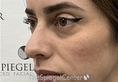 Non-Surgical Rhinoplasty / Nose Filler Before & After Gallery - Patient 173666 - Image 3
