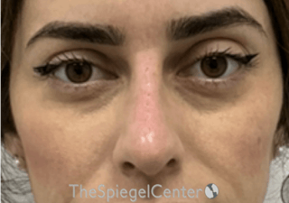 Non-Surgical Rhinoplasty / Nose Filler Before & After Gallery - Patient 173666 - Image 2