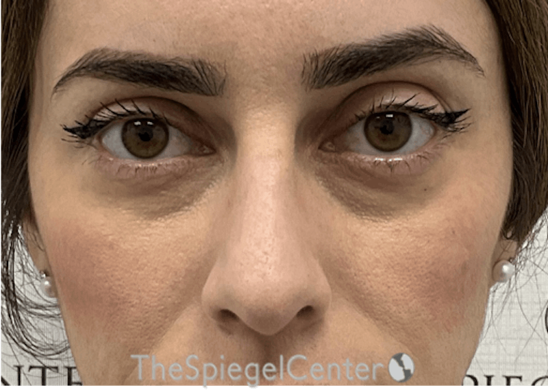 Non-Surgical Rhinoplasty / Nose Filler Before & After Gallery - Patient 173666 - Image 1