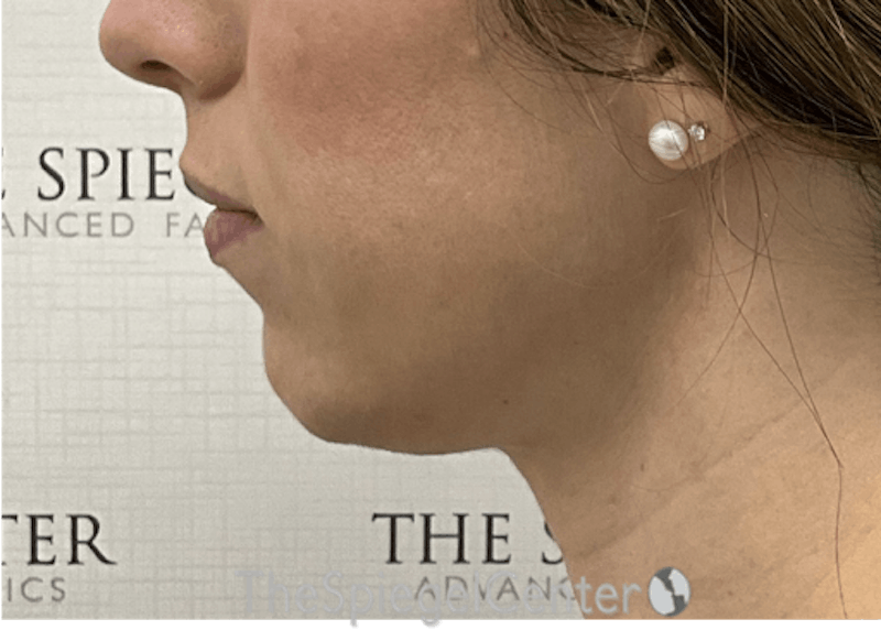 Chin Filler Before & After Gallery - Patient 262521 - Image 3