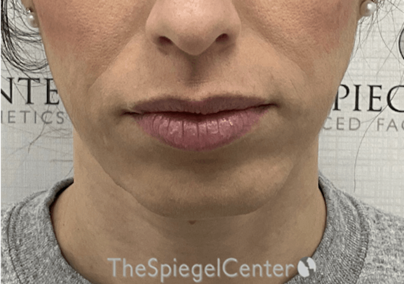 Chin Filler Before & After Gallery - Patient 262521 - Image 1