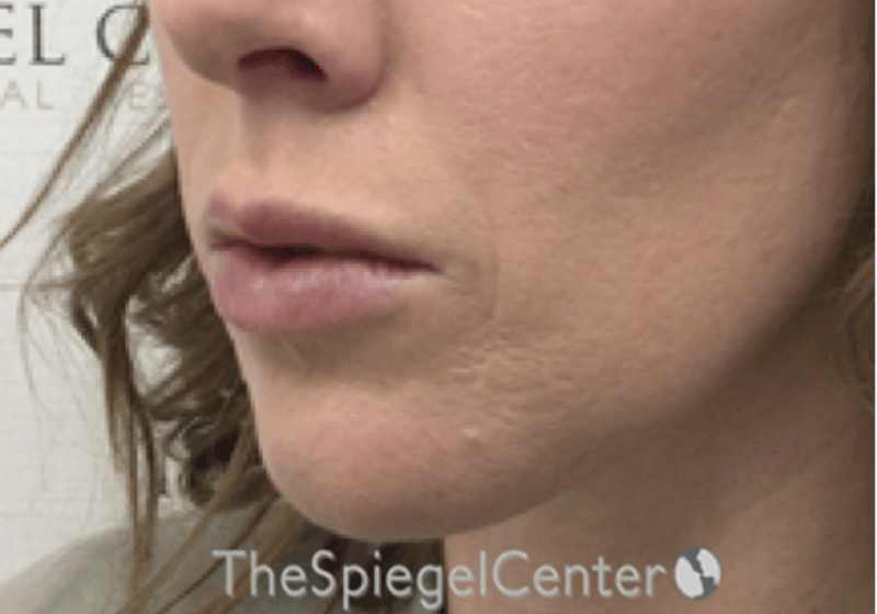Nasolabial Fold Filler Before & After Gallery - Patient 314365 - Image 4