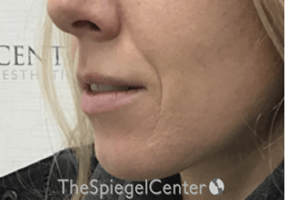 Nasolabial Fold Filler Before & After Gallery - Patient 314365 - Image 3