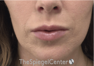 Nasolabial Fold Filler Before & After Gallery - Patient 314365 - Image 2
