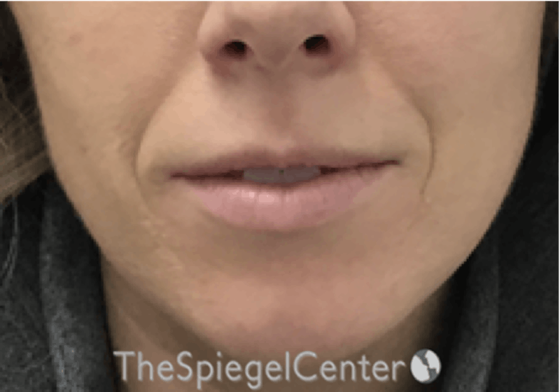 Nasolabial Fold Filler Before & After Gallery - Patient 314365 - Image 1