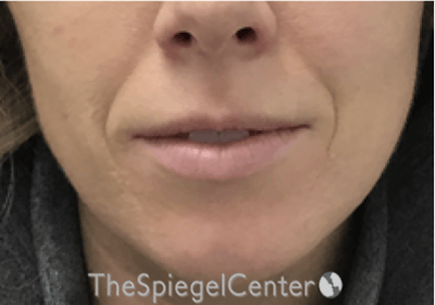 Nasolabial Fold Filler Before & After Gallery - Patient 314365 - Image 1