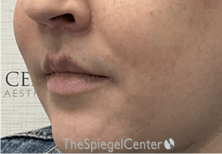 Lip Lift Before & After Gallery - Patient 206972 - Image 4