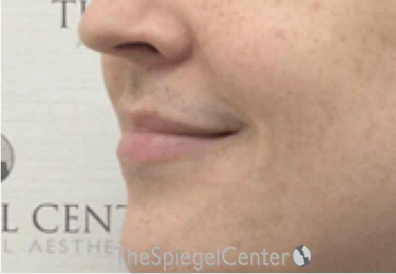 Lip Lift Before & After Gallery - Patient 206972 - Image 3