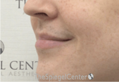Lip Lift Before & After Gallery - Patient 206972 - Image 3
