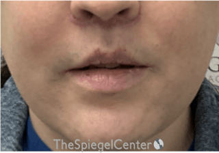 Lip Lift Before & After Gallery - Patient 206972 - Image 2