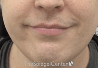 Lip Lift Before & After Gallery - Patient 206972 - Image 1