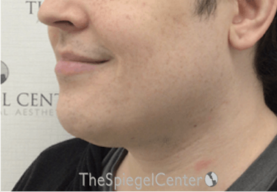 Mandible Contouring Before & After Gallery - Patient 131462 - Image 3