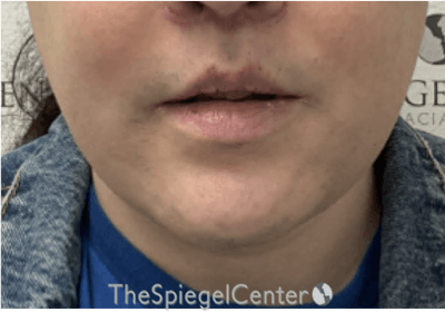 Mandible Contouring Before & After Gallery - Patient 131462 - Image 2