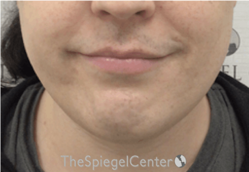 Mandible Contouring Before & After Gallery - Patient 131462 - Image 1