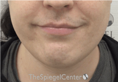 Mandible Contouring Before & After Gallery - Patient 131462 - Image 1