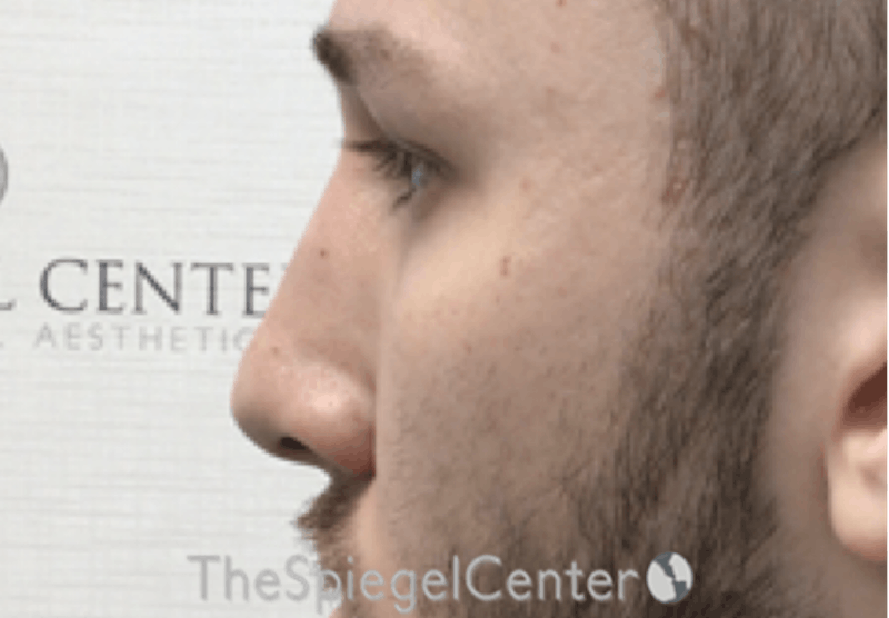 Non-Surgical Rhinoplasty / Nose Filler Before & After Gallery - Patient 158719 - Image 4