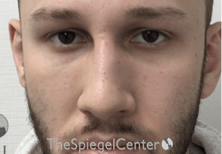 Non-Surgical Rhinoplasty / Nose Filler Before & After Gallery - Patient 158719 - Image 2