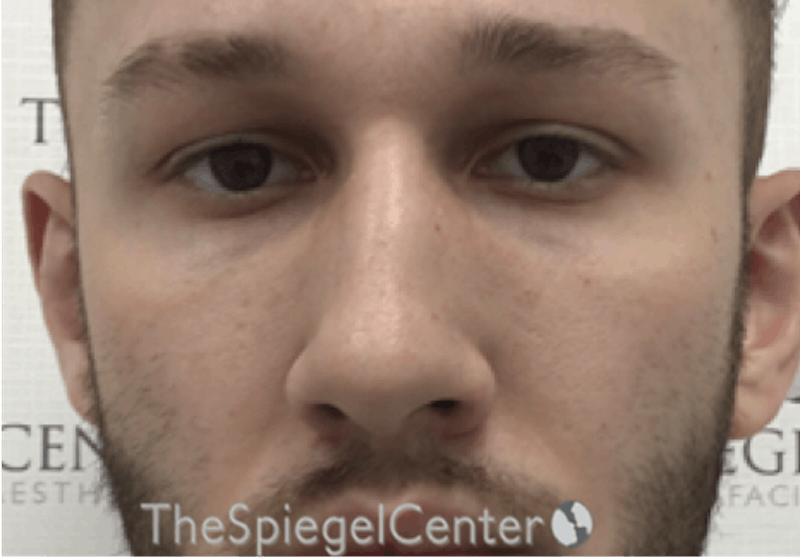 Non-Surgical Rhinoplasty / Nose Filler Before & After Gallery - Patient 158719 - Image 1