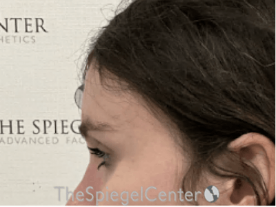 Forehead Contouring Before & After Gallery - Patient 338830 - Image 4