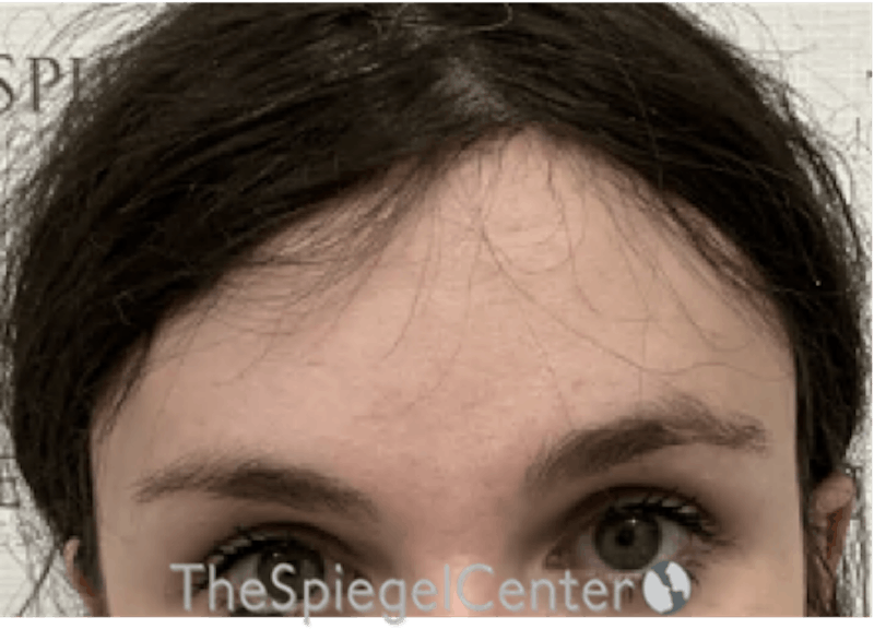 Forehead Contouring Before & After Gallery - Patient 338830 - Image 2