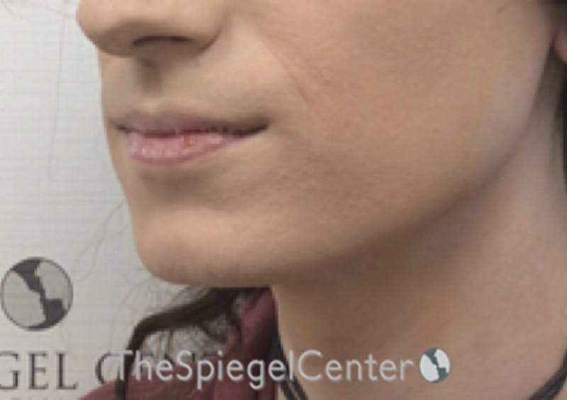Mandible Contouring Before & After Gallery - Patient 158019 - Image 3