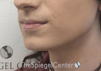 Mandible Contouring Before & After Gallery - Patient 158019 - Image 3