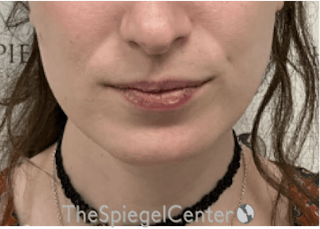 Mandible Contouring Before & After Gallery - Patient 158019 - Image 2