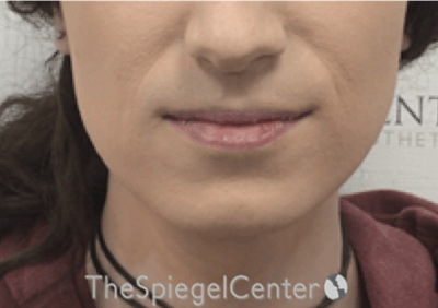 Mandible Contouring Before & After Gallery - Patient 158019 - Image 1