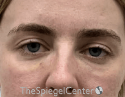Tear Trough / Under Eye Fillers Before & After Gallery - Patient 291052 - Image 2